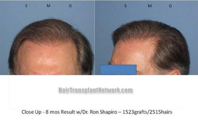 Closeup views of hairline after hair restoration