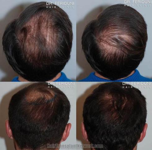 Hair restoration procedure before and after pictures