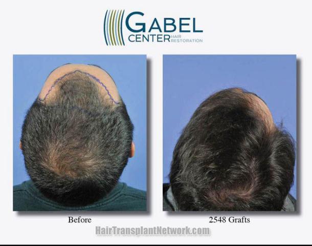 Hair restoration procedure before and after pictures