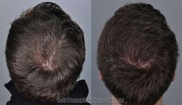 Hair transplantation surgery before and after pictures