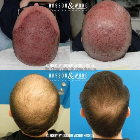 Surgical hair transplantation result photographs