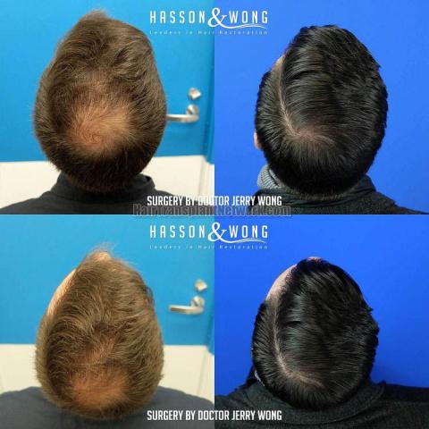 Hair transplantation procedure before and after results