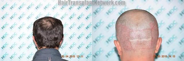 Hair transplantation surgery before and after pictures