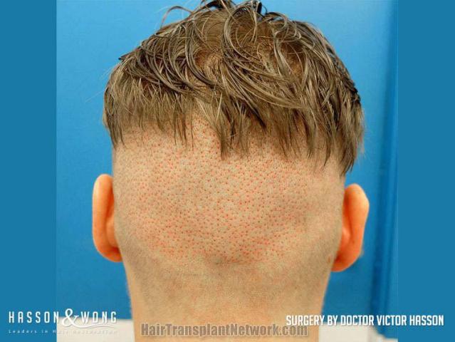 Surgical hair transplantation result photographs