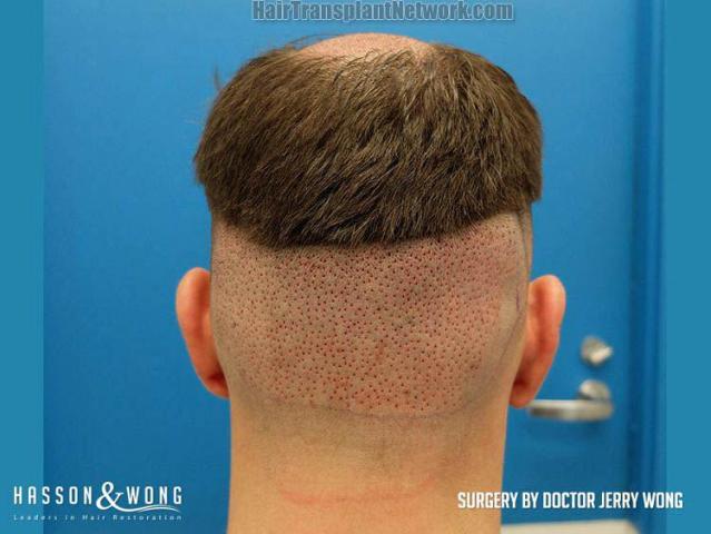 Hair transplantation surgery before and after photos