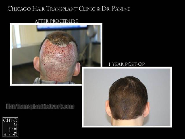 Surgical hair transplantation result photographs