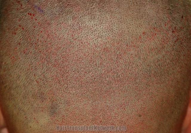 Surgical hair transplantation result photographs