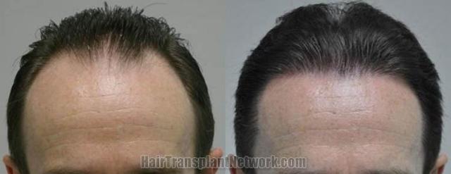 Hair restoration procedure before and after results