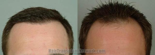 Before and after hair transplantation result photographs