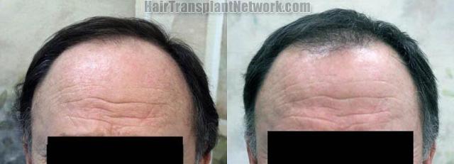 Hair restoration procedure before and after results