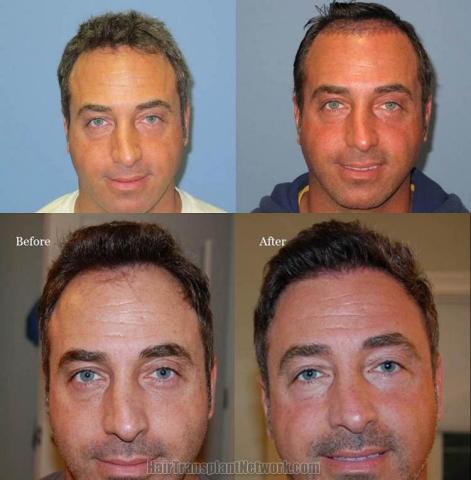 Hair restoration procedure before and after results