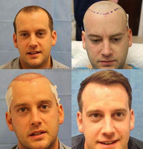 Hair transplantation surgery before and after photos