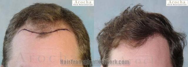 Hair transplantation surgery before and after photos