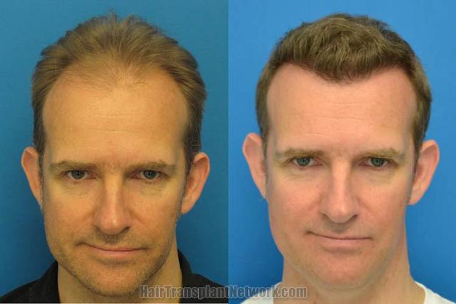 Hair restoration procedure before and after results