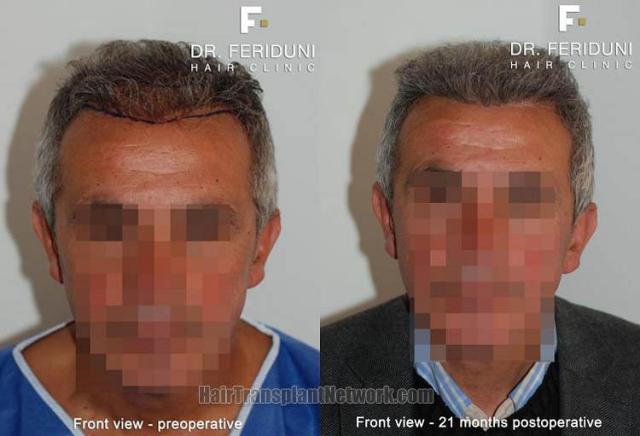 Hair restoration procedure before and after results