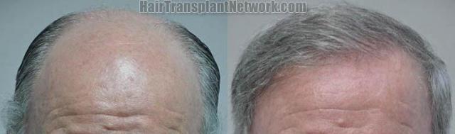 Hair restoration procedure before and after results