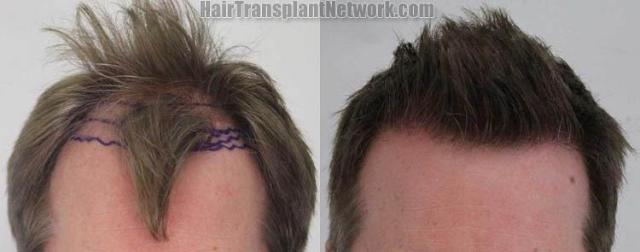 Hair transplantation surgery before and after pictures