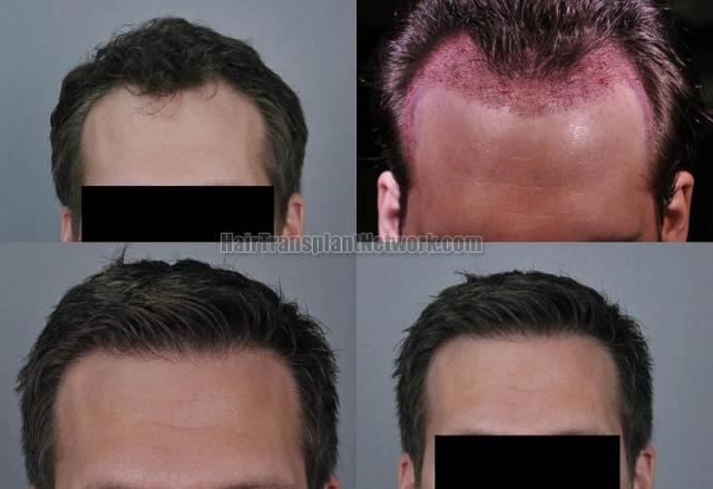 Hair transplantation surgery before and after photos