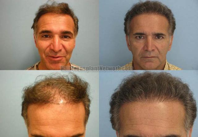 Hair transplantation surgery before and after photos