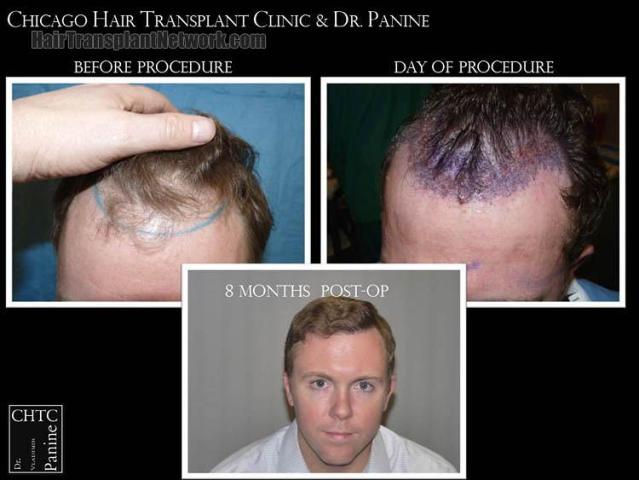 Hair restoration procedure before and after results