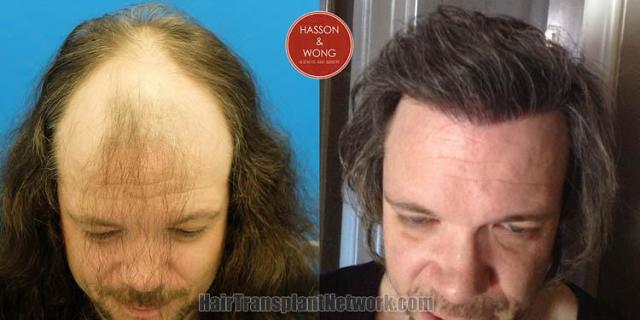 Hair restoration procedure before and after results