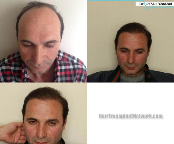 Hair transplantation surgery before and after pictures