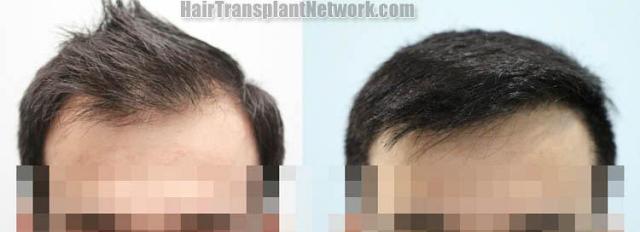 Hair restoration procedure before and after results