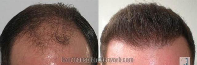 Hair restoration procedure before and after results