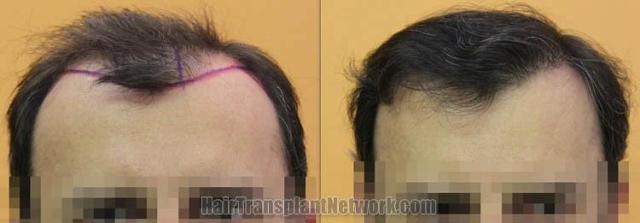 Before and after hair transplant procedure images