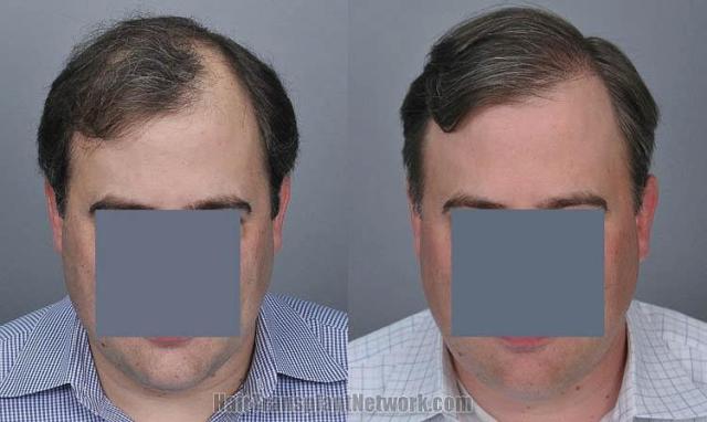 Hair restoration procedure before and after results