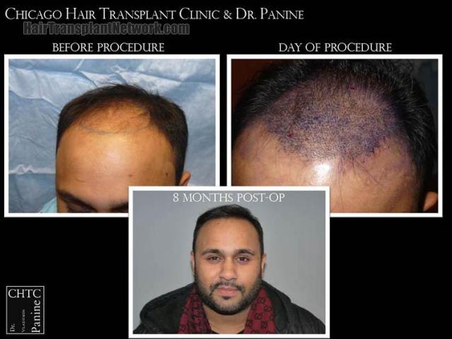 Hair restoration procedure before and after results