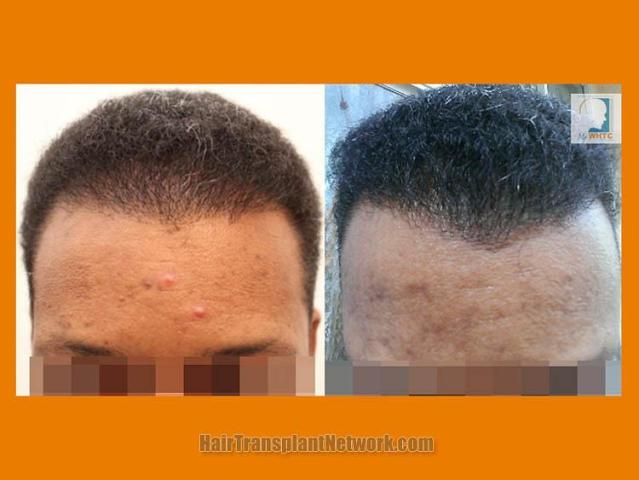 Before and after hair transplant procedure images