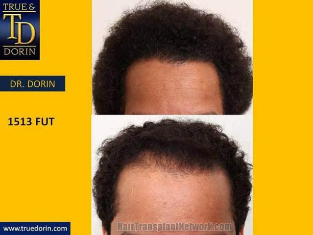 Hair transplantation surgery before and after images