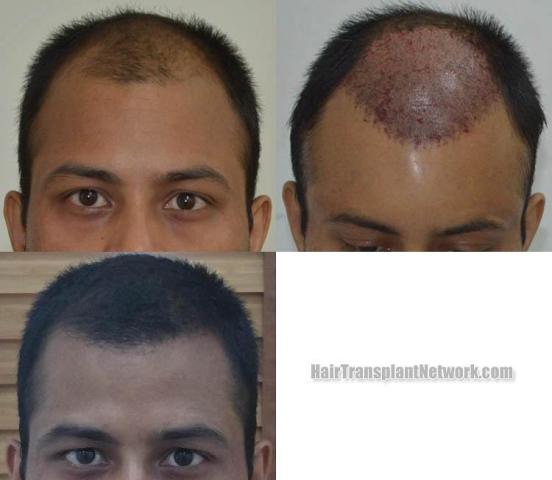 Before and after hair transplant procedure images