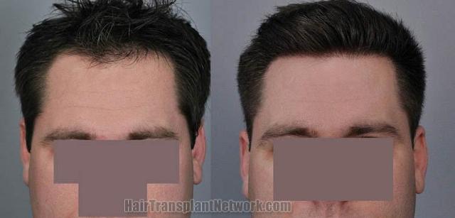 Before and after hair transplant procedure images