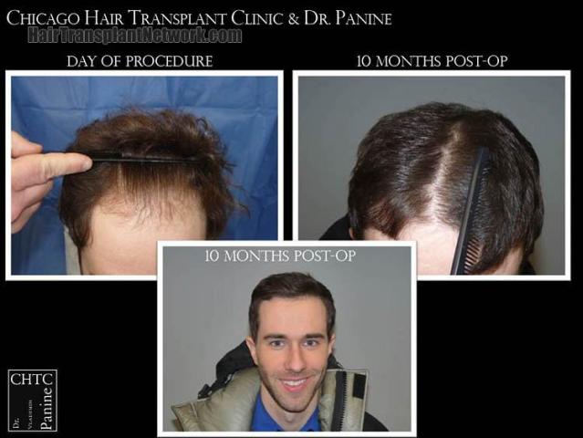 Hair restoration procedure before and after results