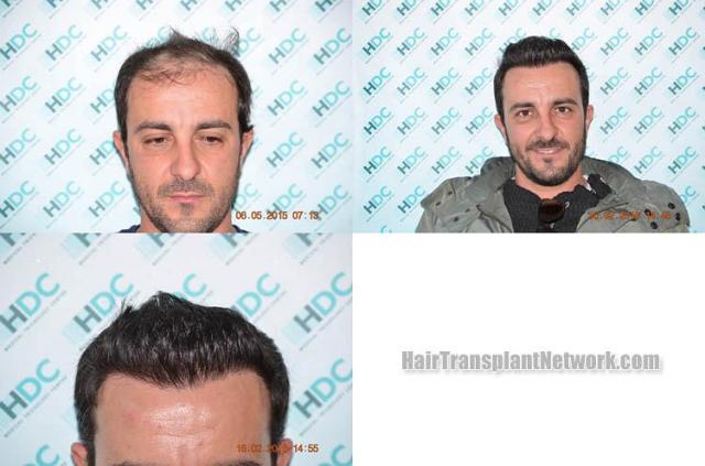 Before and after hair transplant procedure images