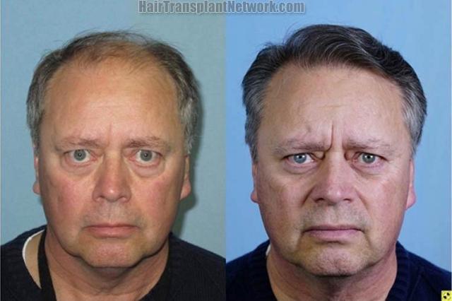 Before and after hair transplantation surgery