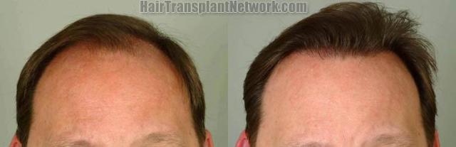 Front view - Before and after hair transplantation surgery