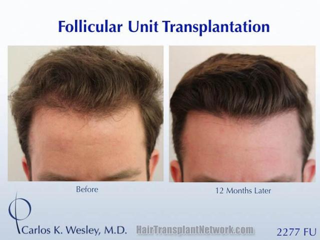 Hair restoration procedure before and after results