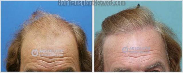 Front view - Before and after hair transplantation surgery