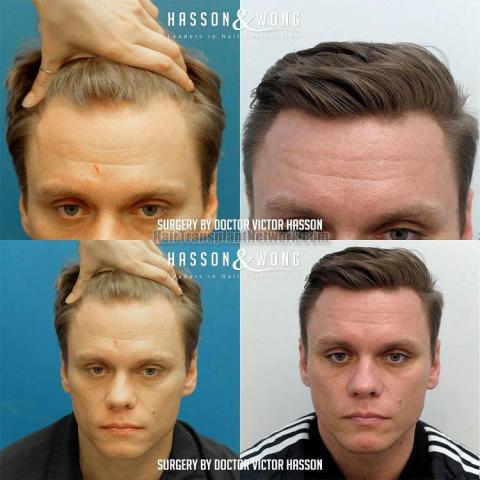 Front view - Before and after hair restoration procedure