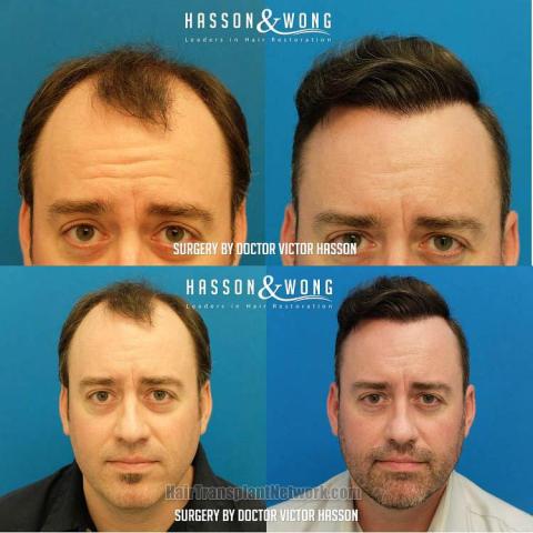 Before and after hair restoration procedure images