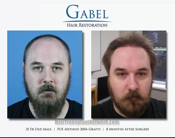 Before and after hair restoration procedure images