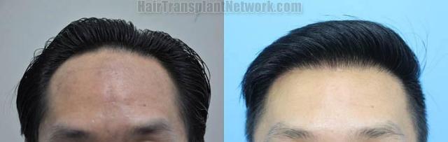 Front view - Before and after hair restoration procedure