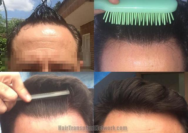 Before and after hair restoration procedure images