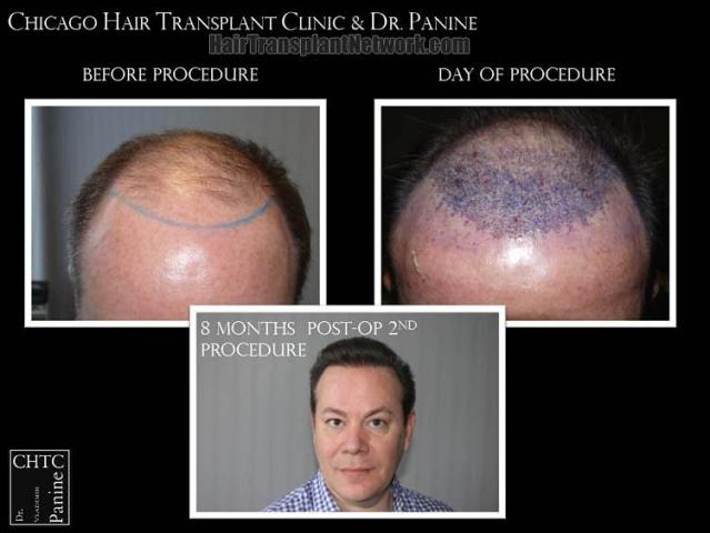 Front view - Before and after hair restoration procedure