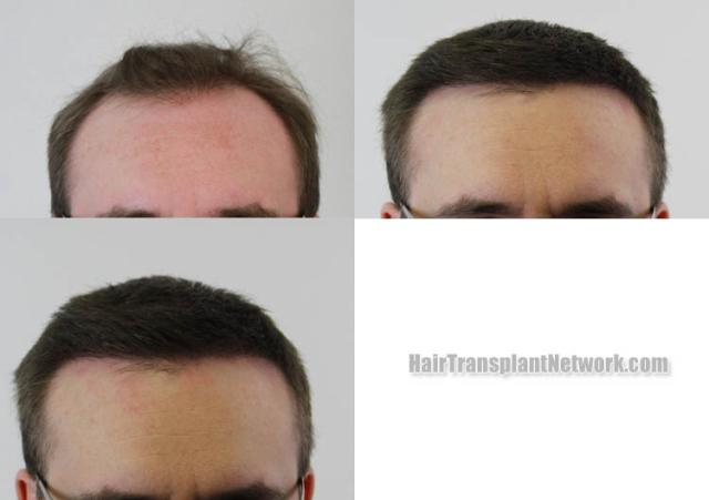 Before and after hair restoration procedure images