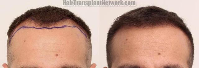 Front view - Before and after hair restoration procedure