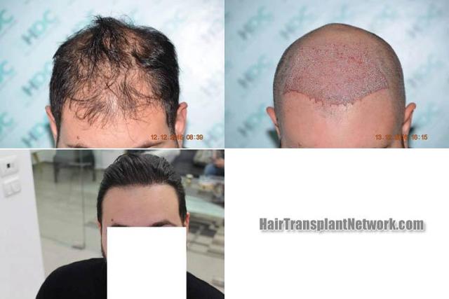 Front view - Before and after hair restoration procedure